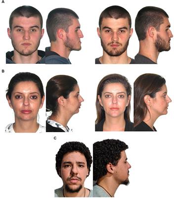 Impact of dentofacial deformity on the chance of being hired for a job